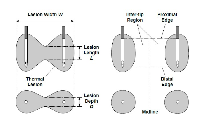  RF heat lesion size and influencing factors image right