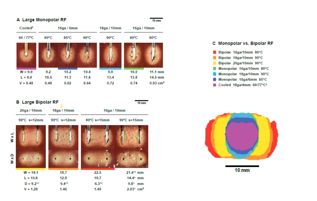  Average size of large RF lesions – Monopolar vs Bipolar RF. A image