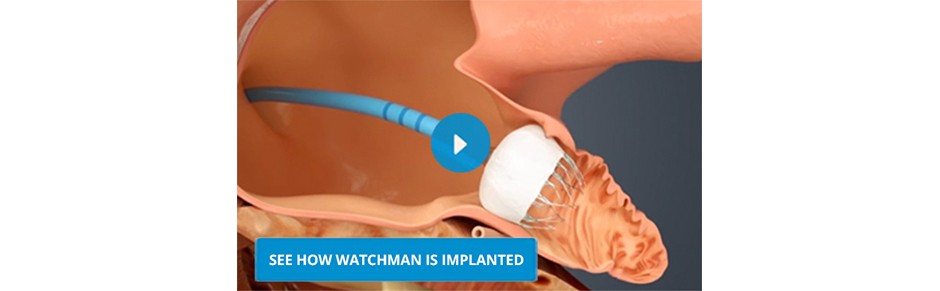 See how WATCHMAN LAAC Device is implanted
