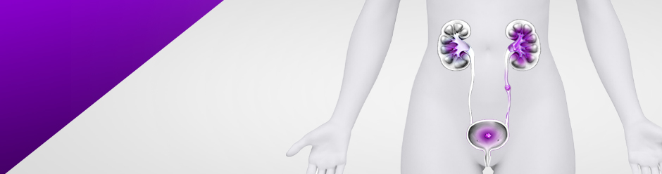 kidney-stones-cystine-calcium-struvite-uric-acid