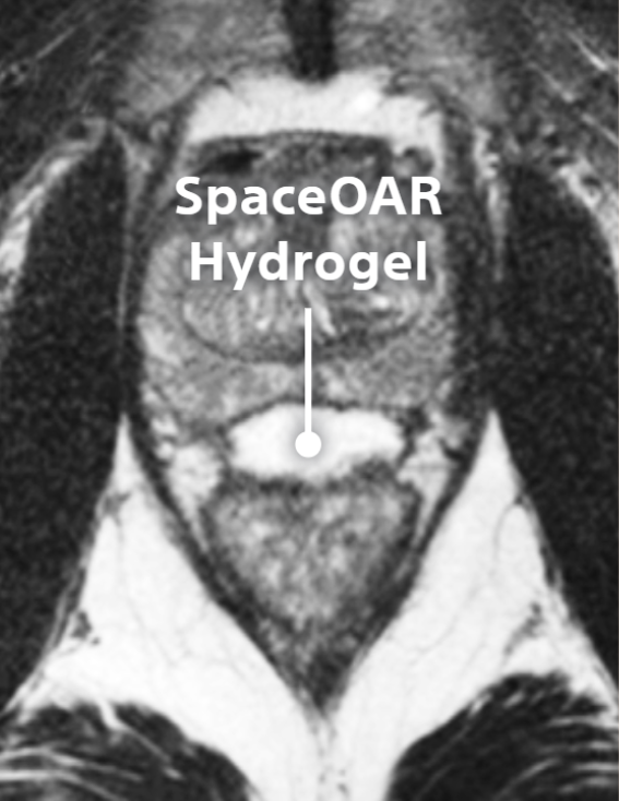 SpaceOAR Hydrogel