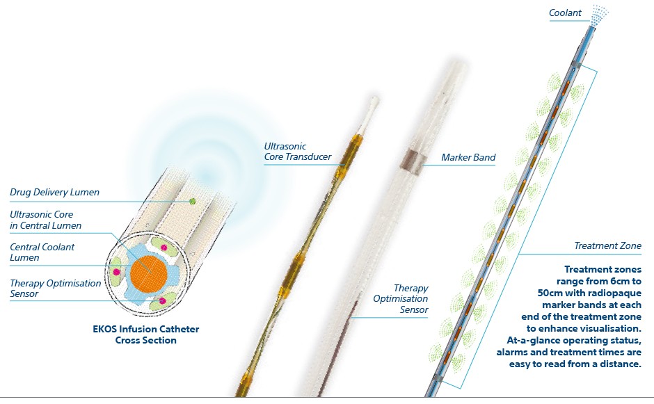 The EkoSonic™ Endovascular System includes an ultrasonic core within an infusion catheter, and control unit.
