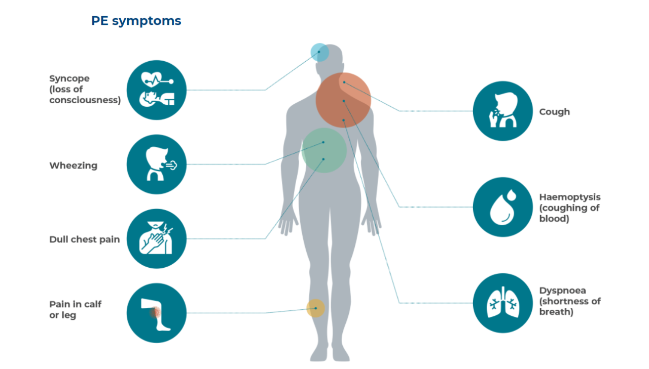 Common symptoms for pulmonary embolism