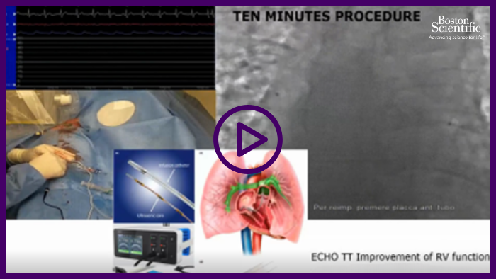 The treatment of intermediate high-risk PE