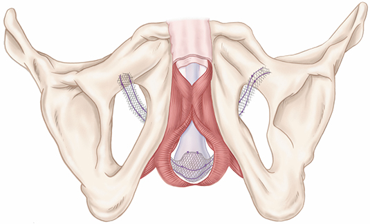 male-sling-system-placement