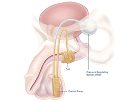 artificial urinary sphincter placement