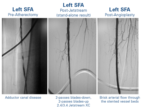 Jetstream Atherectomy Treatment of a Long, Diffuse ISR Disease