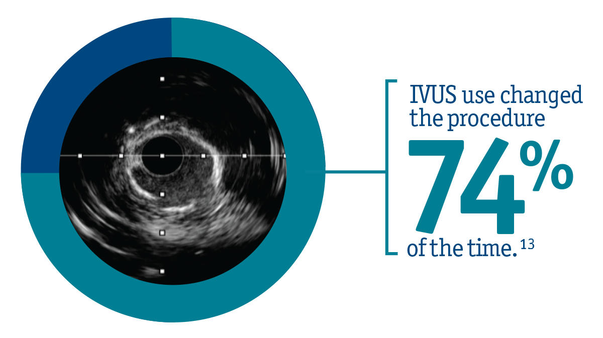 In fact, the use of IVUS has been shown to change treatment decisions 74% of the time. ​