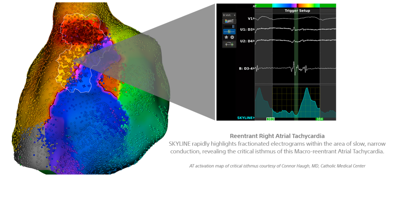 Reentrat Right Atrial Tachycardia