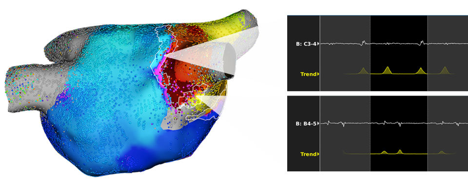 Redo atrial fibrillation