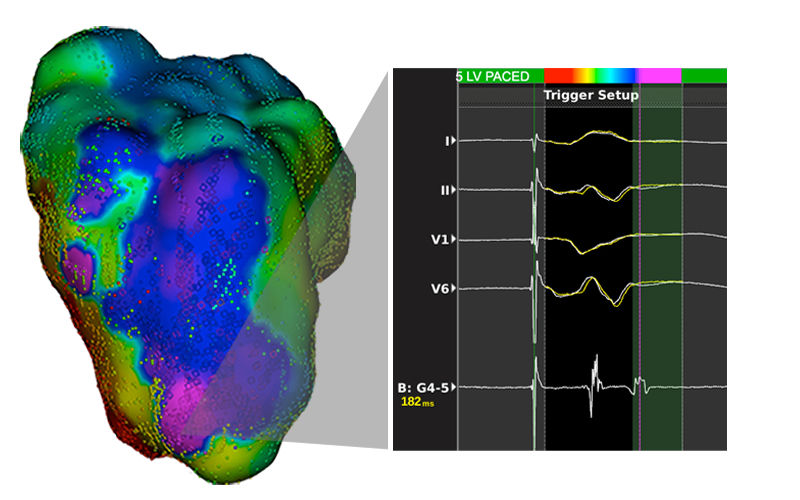 LUMPOINT Group Reannotation facilitates automatic reannotation to the late potentials, instead of far-field systolic potentials.