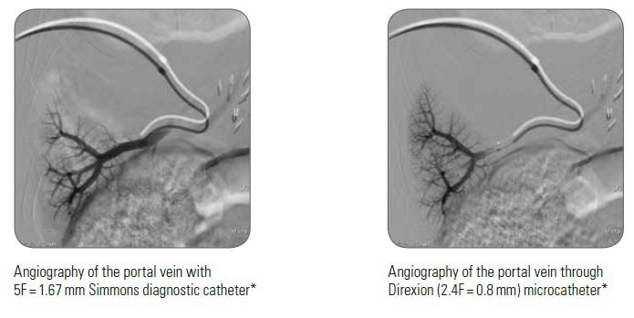 Angiography of the portal vein through Direxion