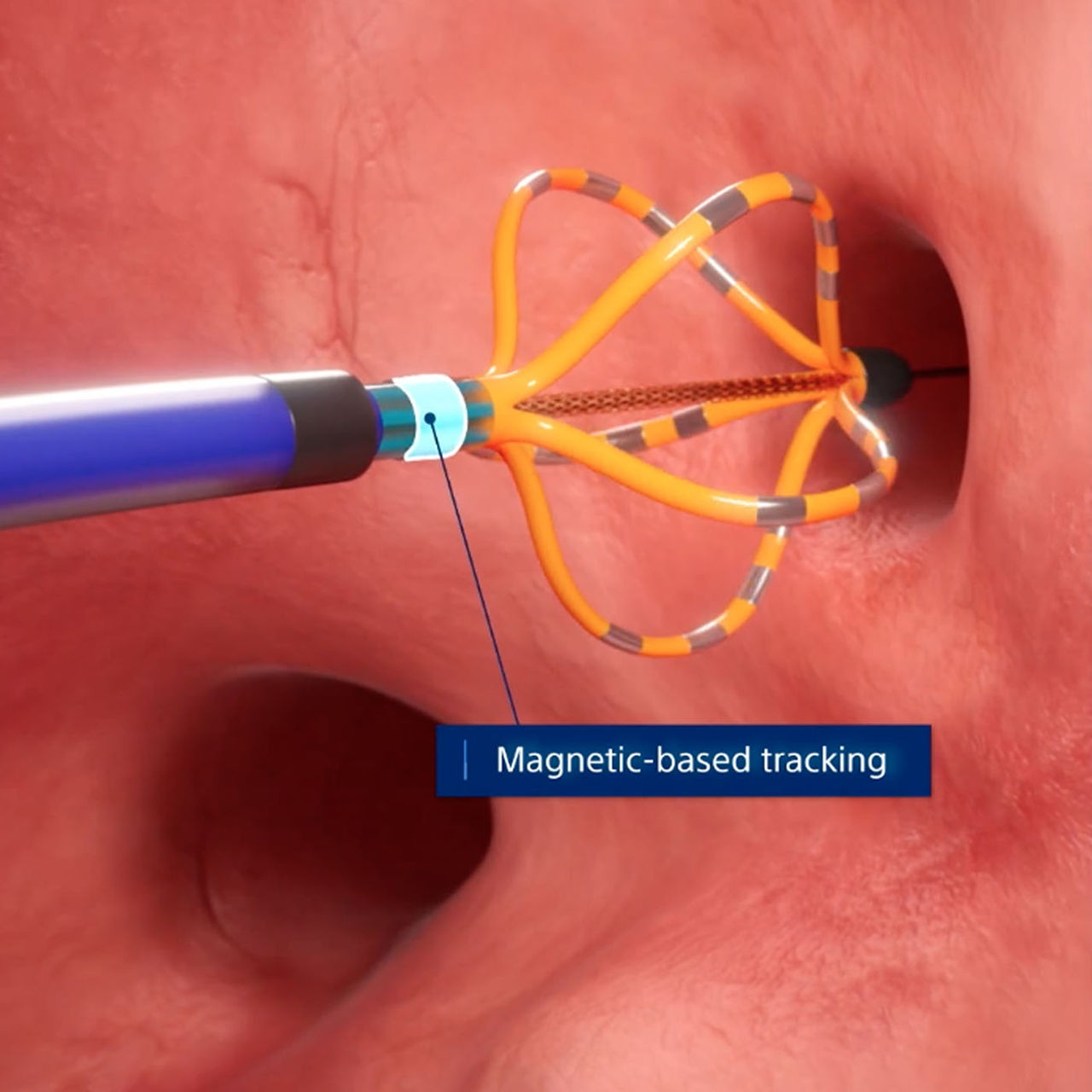 FARAWAVE NAV catheter with magnetic-based tracking navigating inside a human organ
