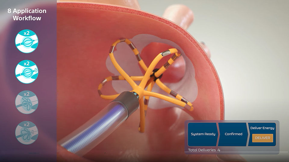 FARAPULSE dosing protocol illustrated with efficient multi-shape delivery.