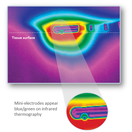 Mini-electrodes appear blue/green on infrared thermography