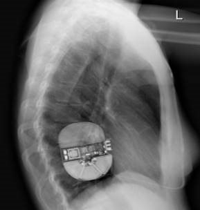 Optimal S-ICD Side View Placement