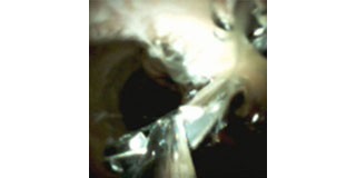 Using Cholangioscopy to Stage for Ampullectomy by Dr Sharma