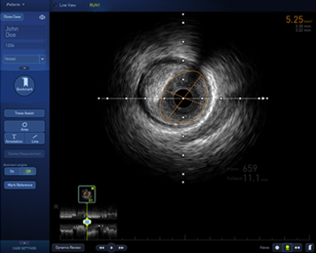 Easy integration of FFR and IVUS into the cath lab - IVUS Image