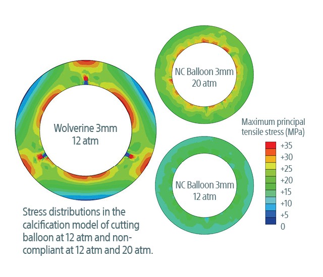 WOLVERINE™ Cutting Balloon MicroSurgical Dilatation Catheter Boston