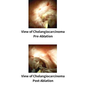 Pre and Post Ablation views of Cholangiocarcinoma
