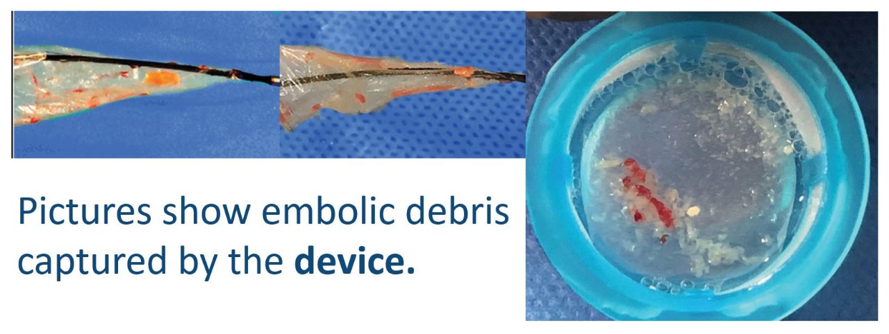 embolic debris captured by the device