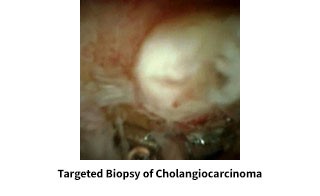 Targeted Biopsy of Cholangiocarcinoma
