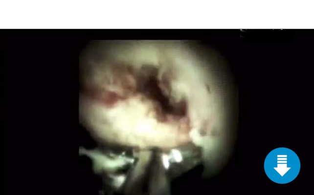Biopsy of a stricture