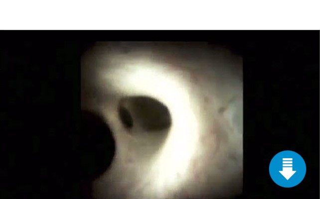 Direct visualization of a stricture in the right and left hepatic ducts diagnosed as cancer using the SpyGlass DS System
