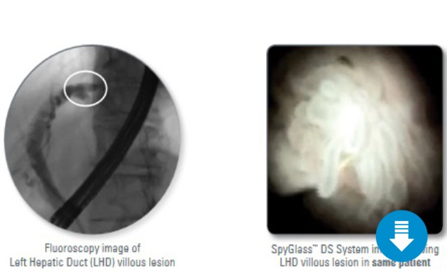LHD Villous Lesion Fluroscopy Vs Digital