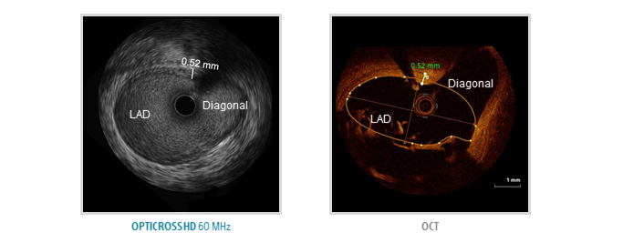 OPTICROSS HD 60 MHz Imaging Catheter vs. OCT