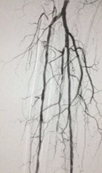 Case CLI with Right Foot Ulcer Thrombectomy post-procedure arteriogram