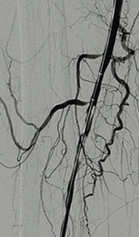Thrombectomy of Occluded SFA - thrombus removed
