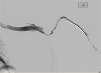 Thrombectomy of Left Brachial Artery-Axillary Vein Graft baseline