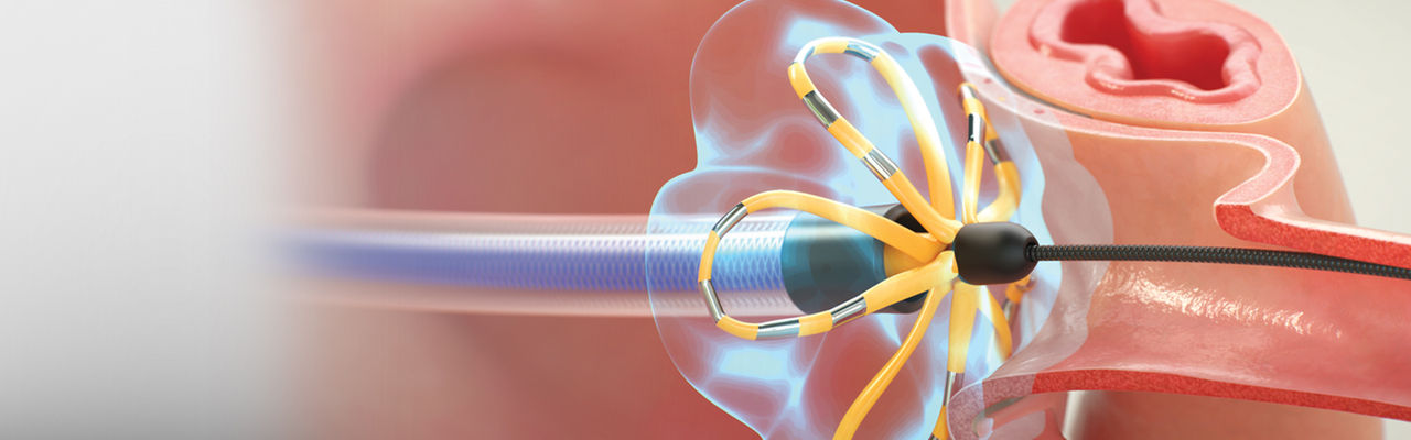 An intranal body illustration of the FARAWAVE catheter