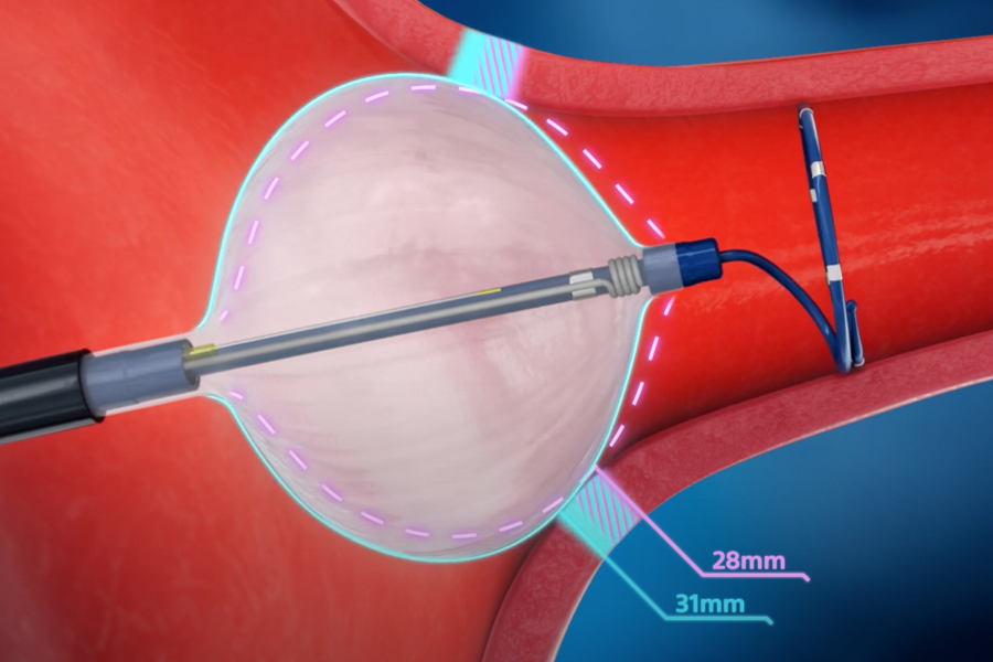 Image of POLARx ballon device showing the two balloon sizes (28mm and 31mm) in one catheter
