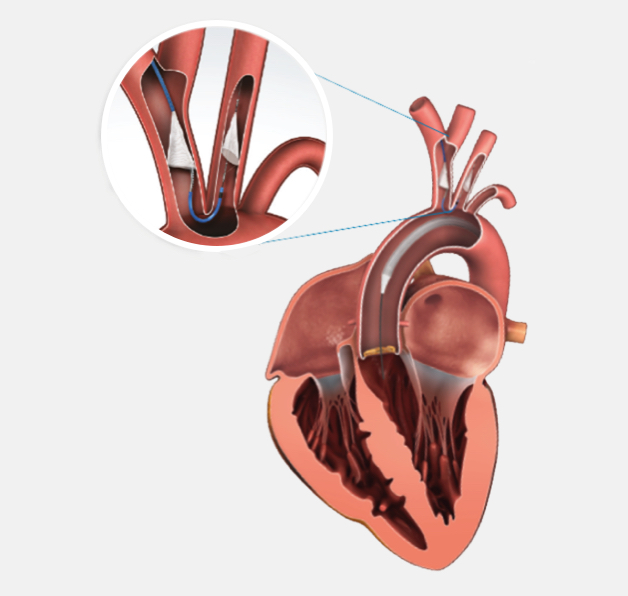 Internal cardiovascular illustration showing the placement of the SENTINEL™ Cerebral Protection System device