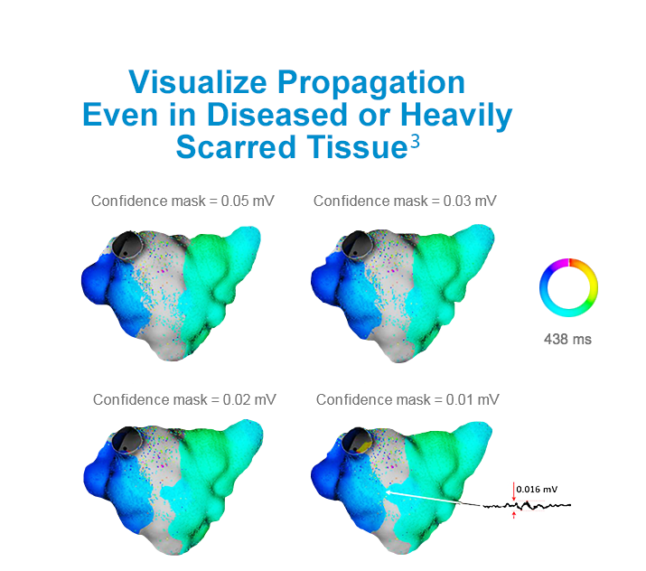 Visualize Propagation Even in Diseased or Heavily Scarred Tissue