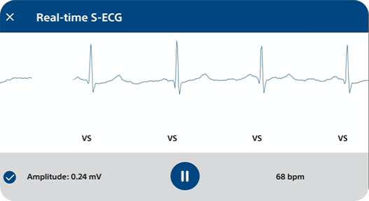 Real-time S-EGC from Boston Scientific LUX-Dx II+ Insertable Cardiac Monitor, on smartphone screen, with amplitude and bpm.
