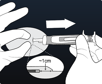Hands removing LUX-Dx tool and closing using standard surgical techniques.
