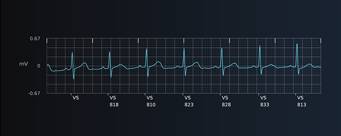 Presenting S-ECG report strip from Boston Scientific LUX-Dx II+ Insertable Cardiac Monitor.