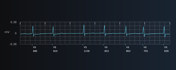 S-ECG from Atrial fibrillation alert report strip from Boston Scientific LUX-Dx II+ Insertable Cardiac Monitor.