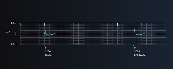 Pause S-ECG report strip from Boston Scientific LUX-Dx II+ Insertable Cardiac Monitor.