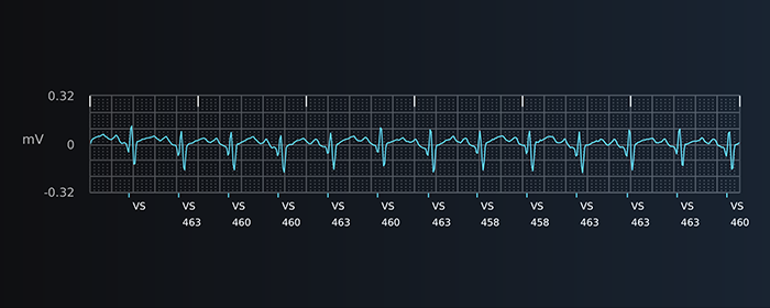 Atrial Tachycardia S-ECG report strip from Boston Scientific LUX-Dx II+ Insertable Cardiac Monitor.