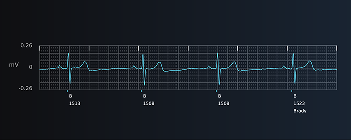 Bradycardia S-ECG report strip from Boston Scientific LUX-Dx II+ Insertable Cardiac Monitor.