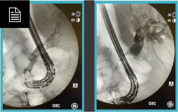 Two images of EXALT Model D Single-Use Duodenoscope with SpyGlass in use