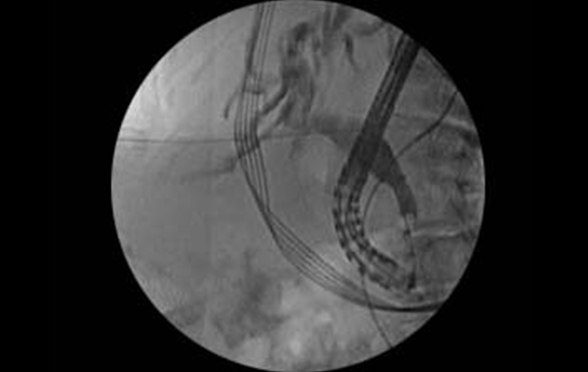 Two images of EXALT Model D Single-Use Duodenoscope with SpyGlass in use