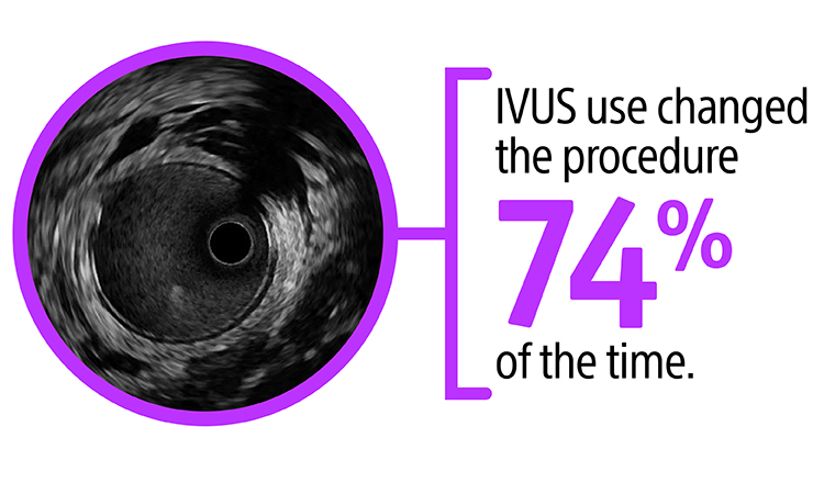 IVUS use changed the procedure 74% of the time.