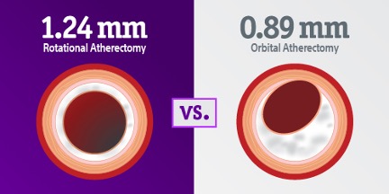 Greater plaque modification for rotational than orbital atherectomy.