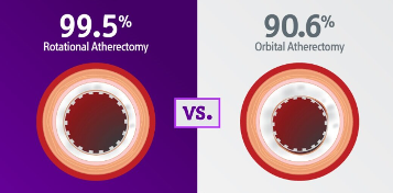 Greater stent expansion for rotational than orbital atherectomy.