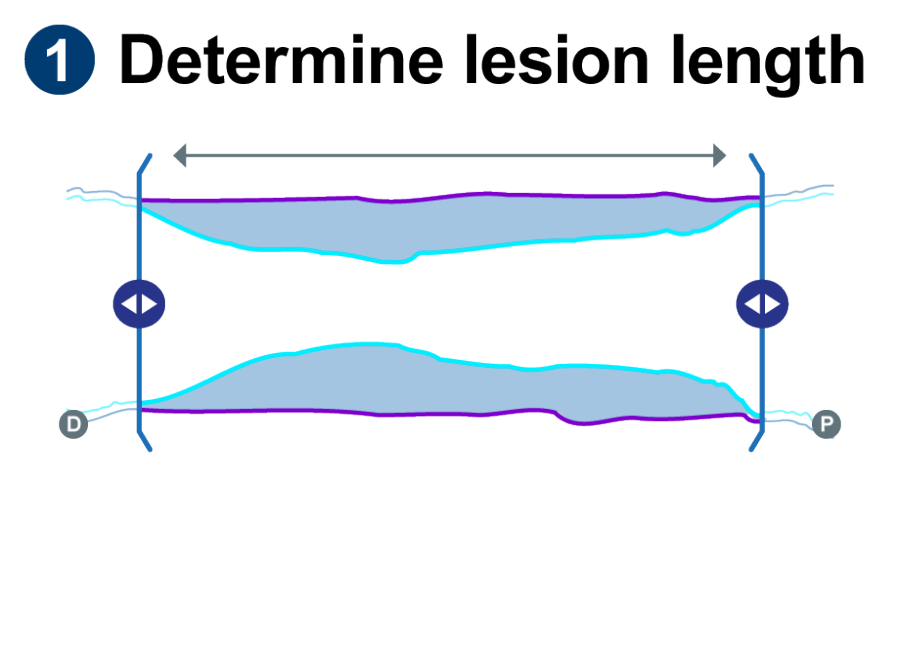 Learn how to IVUS with this simple workflow - Boston Scientific